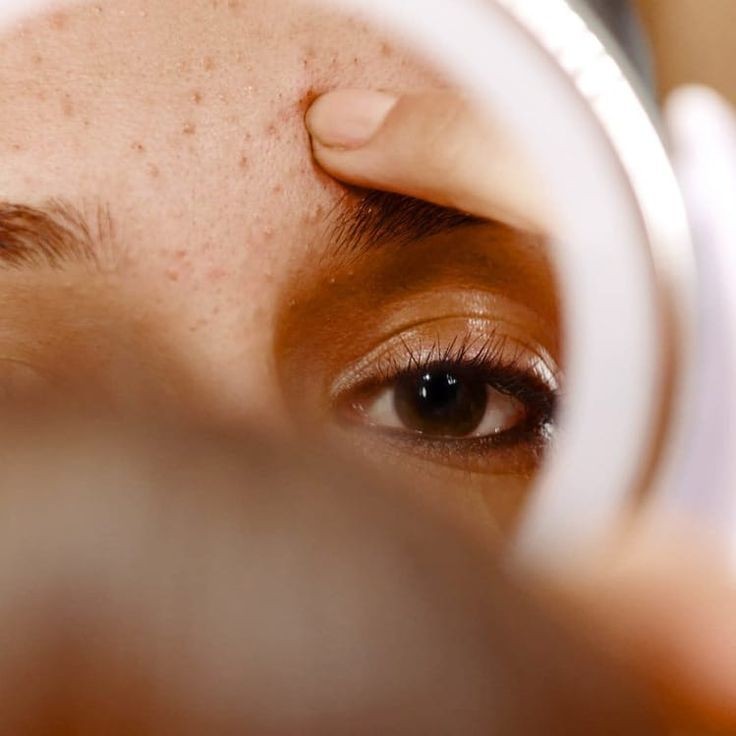 Tratamiento para el acné